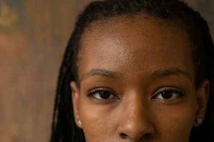 Titilade Ilesanmi: How My Face Acne Affected My Self Esteem 