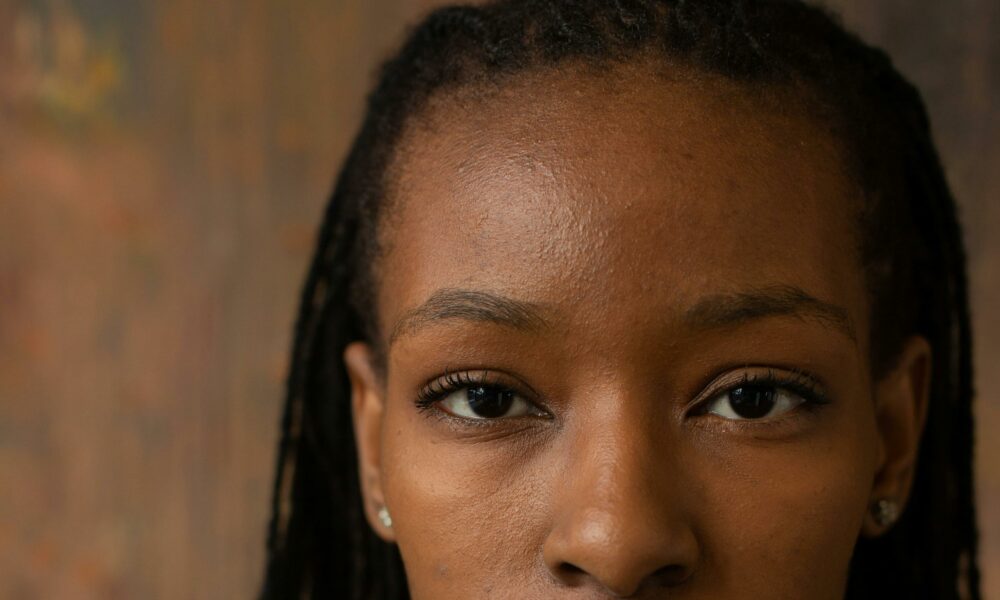 Titilade Ilesanmi: How My Face Acne Affected My Self Esteem 