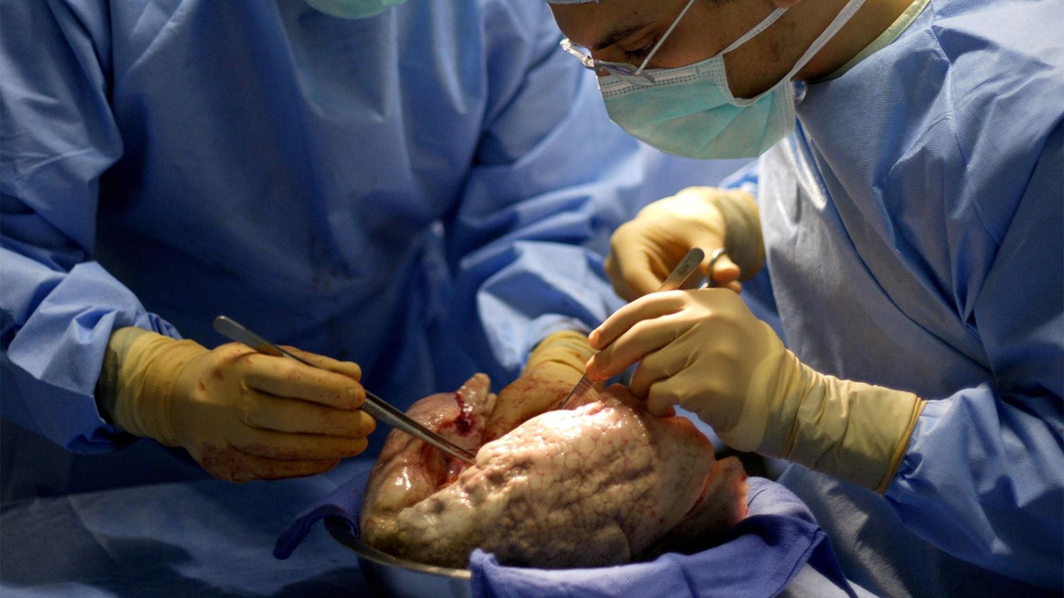 Women’s Disadvantage on Lung Transplant Waitlists May Be a More Global Problem