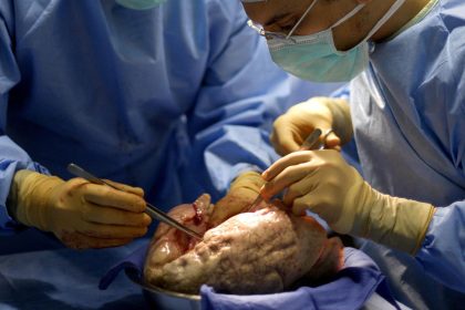 Women’s Disadvantage on Lung Transplant Waitlists May Be a More Global Problem