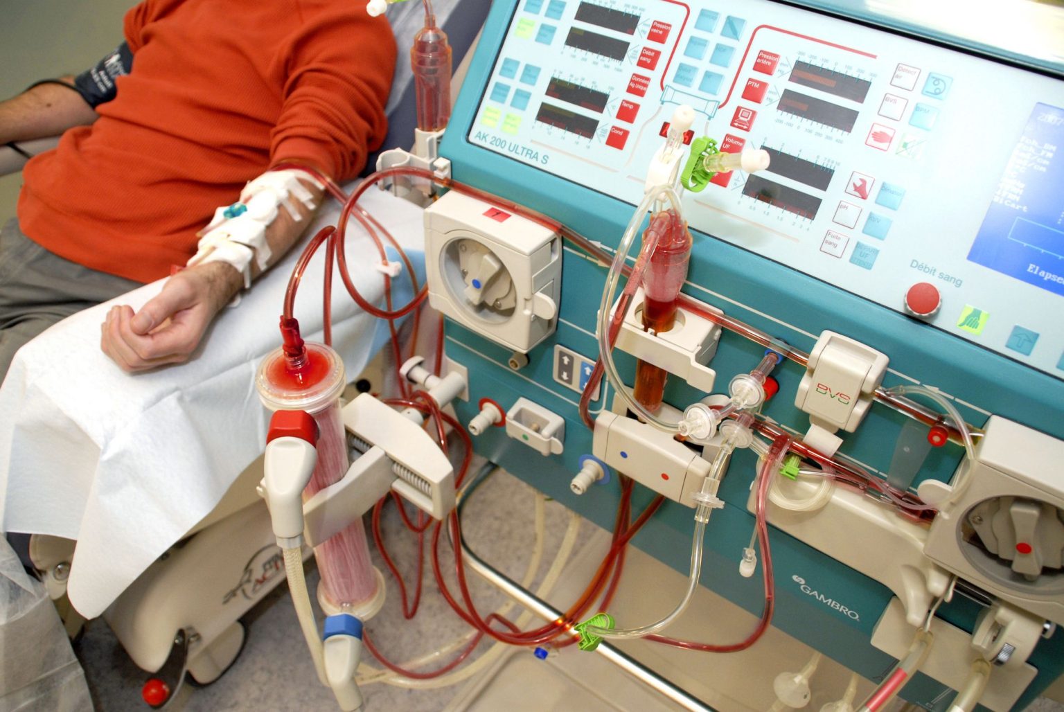 Nigerians with kidney ailments face high dialysis costs as transplant exceeds N14 million 