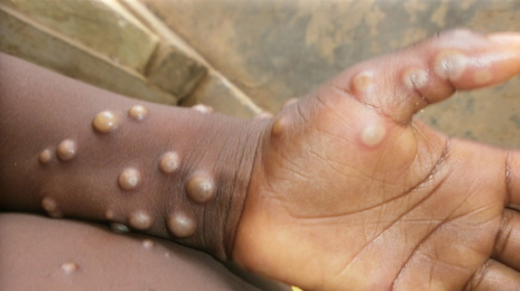Mpox: Africa reports 14,669 cases, 55 deaths in 2024 – WHO Director 