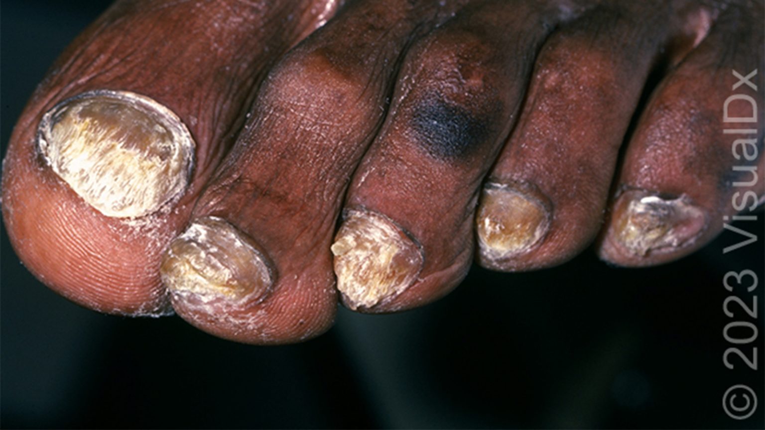 Make the Diagnosis: Are Her Nail Symptoms Part of a Larger Picture?