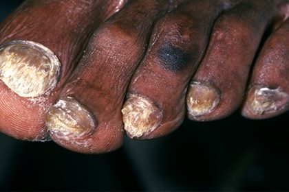 Make the Diagnosis: Are Her Nail Symptoms Part of a Larger Picture?