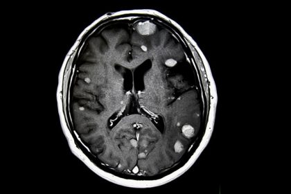 Preoperative Radiosurgery for Brain Metastases Shows Promise