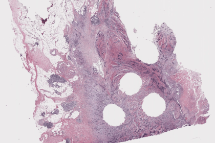 The Download: AI for cancer diagnosis, and HIV prevention