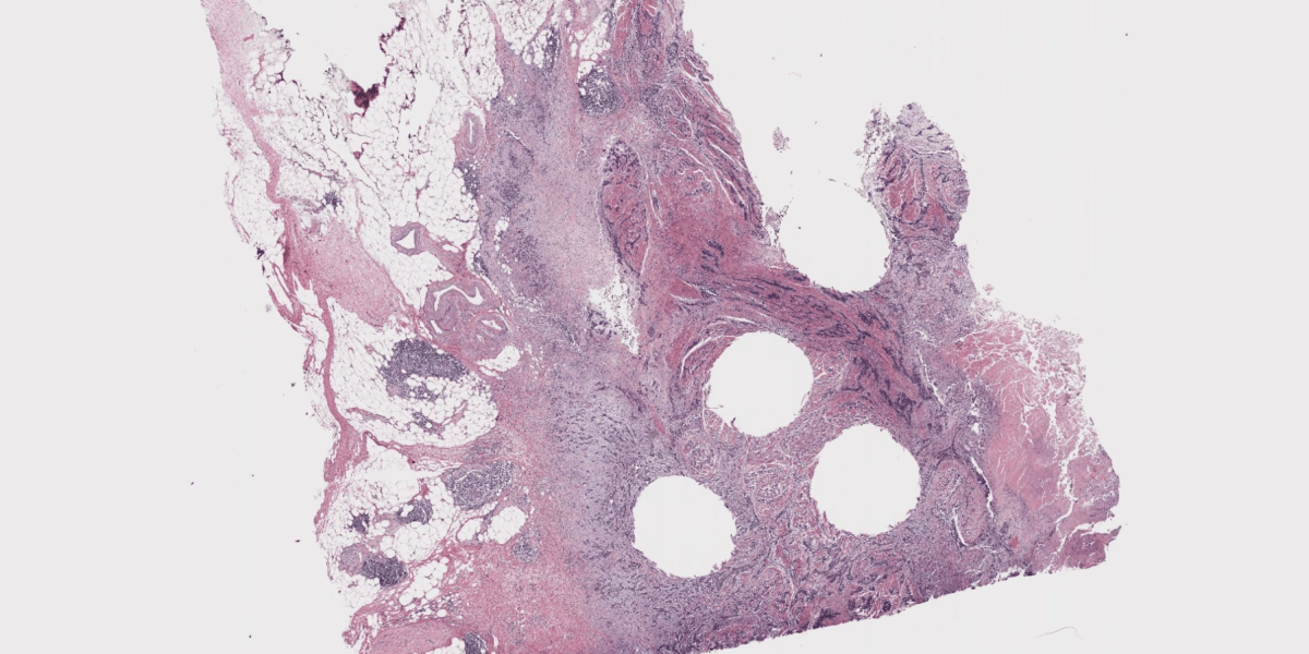 Why it’s so hard to use AI to diagnose cancer