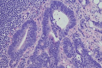 FDA Approves Sotorasib + Panitumumab for mCRC