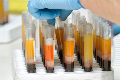 PRP Considered Effective but Not Approved for Hair Loss