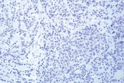 T-DM1 Boosts Survival in HER2-Positive Breast Cancer