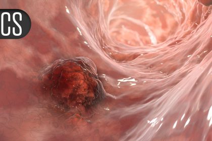 Immunotherapy-TACE Regimen Boosts PFS in Unresectable Liver Cancer