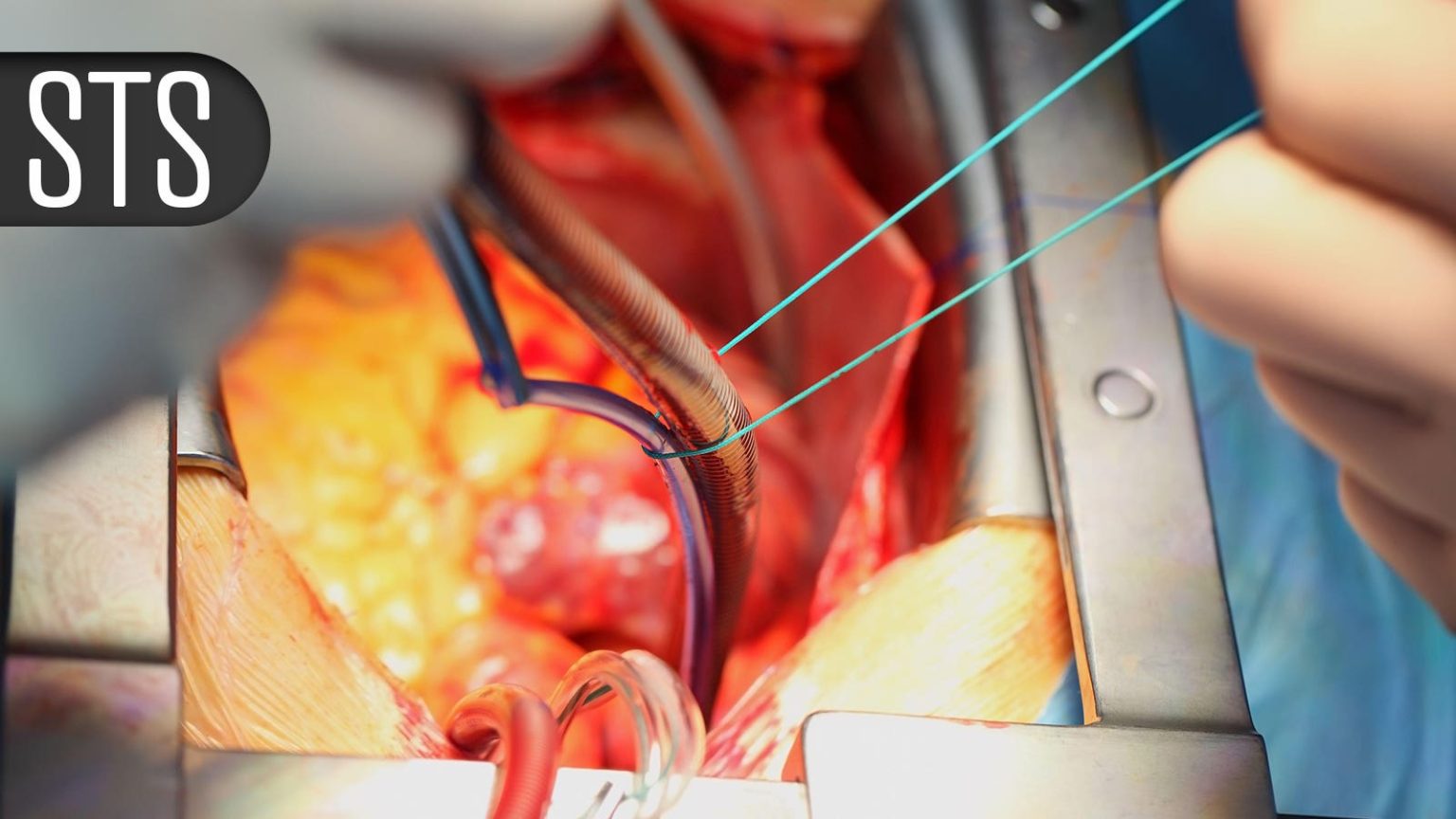 Inhaled Pulmonary Vasodilators for Surgery: Choice Still Up for Debate