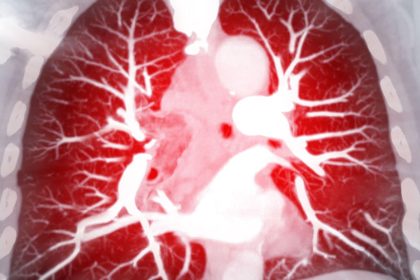 Have the New Pulmonary Hypertension Drugs Changed the Game?