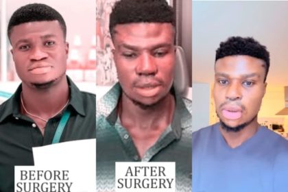 Zicsaloma Does a Full Recap and Real Reason Why He Did a Nose Surgery