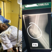 Nigerian Policemen Shatter Musician’s Kneecap With Baseball Bat, Offer N200,000 Compensation After N5Million Surgery
