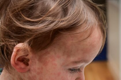 Nine unvaccinated people hospitalized as Texas measles outbreak doubles