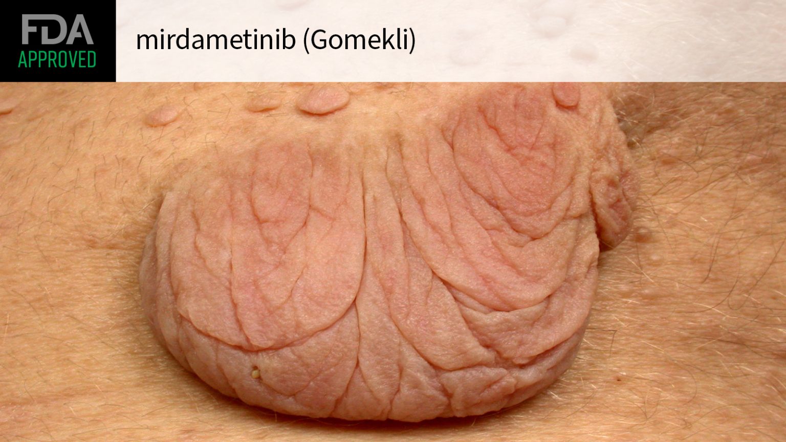 FDA OKs Mirdametinib for Neurofibromatosis Type 1