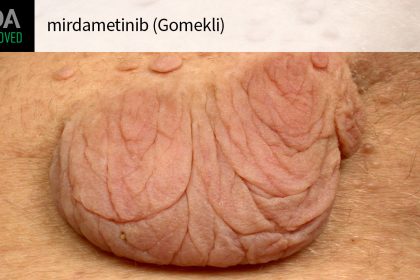 FDA OKs Mirdametinib for Neurofibromatosis Type 1