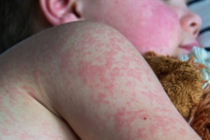 Texas measles outbreak reaches 90 cases; 9 cases in New Mexico