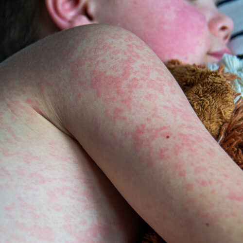 Texas measles outbreak reaches 90 cases; 9 cases in New Mexico
