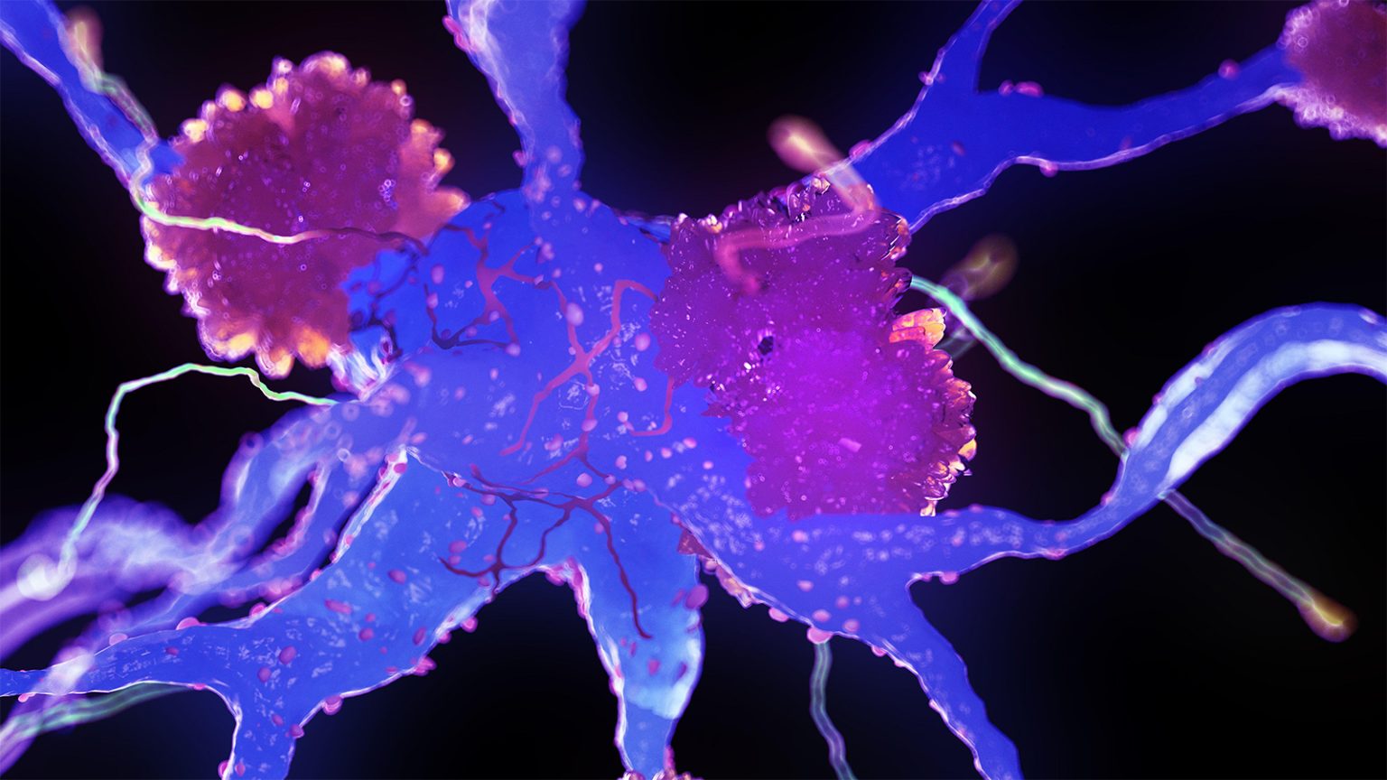 Blood Test Detects Alzheimer’s Pathology in Other Clinical Syndromes