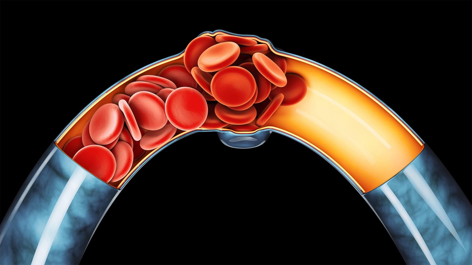 Some Contraceptives Carry Higher Venous Thromboembolism Risk Than Others