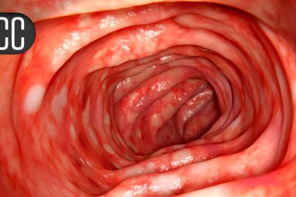 JAK Inhibitors Remain a Viable Option for Older Adults With IBD