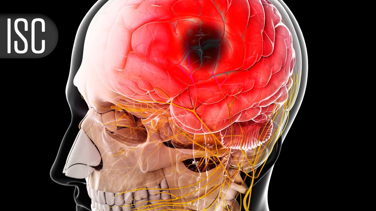 Brain Bleed Survivors Walk a Razor-Thin Line Taking DOACs
