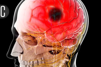 Alteplase Also Shows Its Mettle for Late Strokes in HOPE Trial
