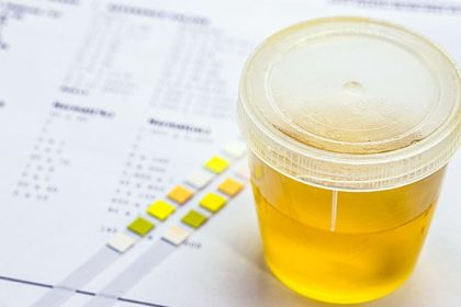 Urine-based Test Shows Promise in Detecting Bladder Cancer