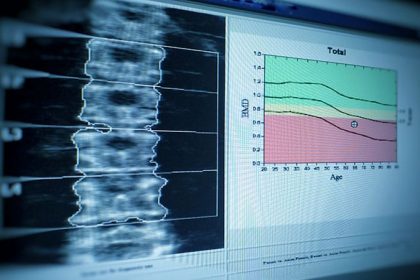 Romosozumab Improves Bone Strength in Women With T2D