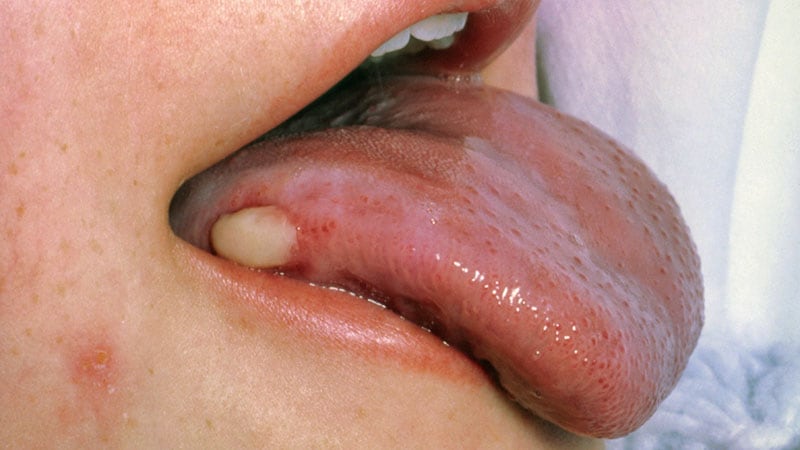 Do Sugary Drinks Increase Oral Cancer Risk?