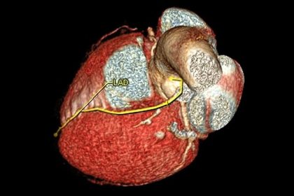 CAC Boosts Statin Adherence, Lowers Plaque: Does It Matter?