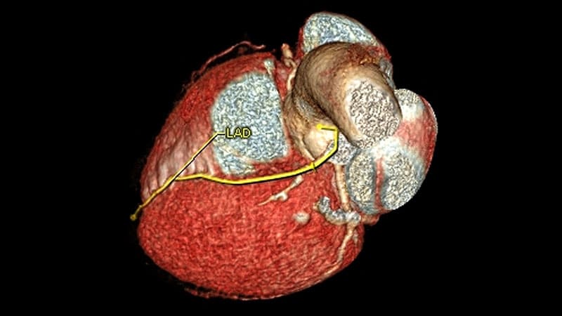 CAC Boosts Statin Adherence, Lowers Plaque: Does It Matter?