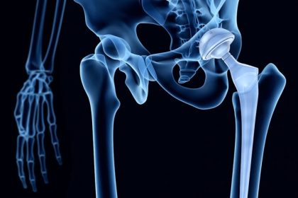 What’s New for Rheumatologists in Hip and Knee Replacement