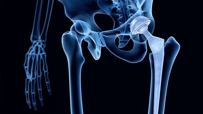 What’s New for Rheumatologists in Hip and Knee Replacement