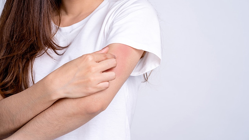 Novel Therapy Shown Effective for Atopic Dermatitis