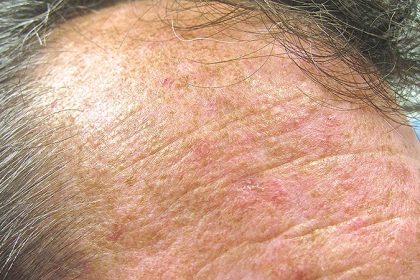 Transplant Recipients Face High Risk for Actinic Keratosis