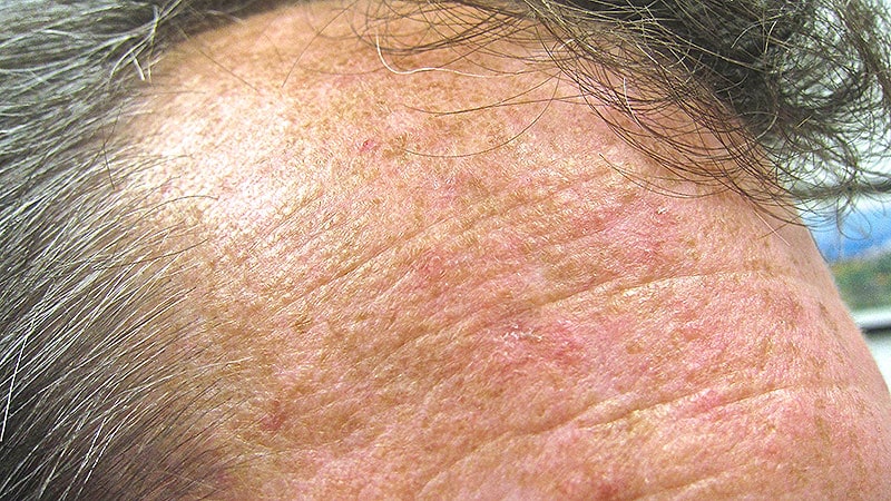 Transplant Recipients Face High Risk for Actinic Keratosis