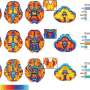 AI-driven MRI analysis improves accuracy in distinguishing Parkinsonian disorders