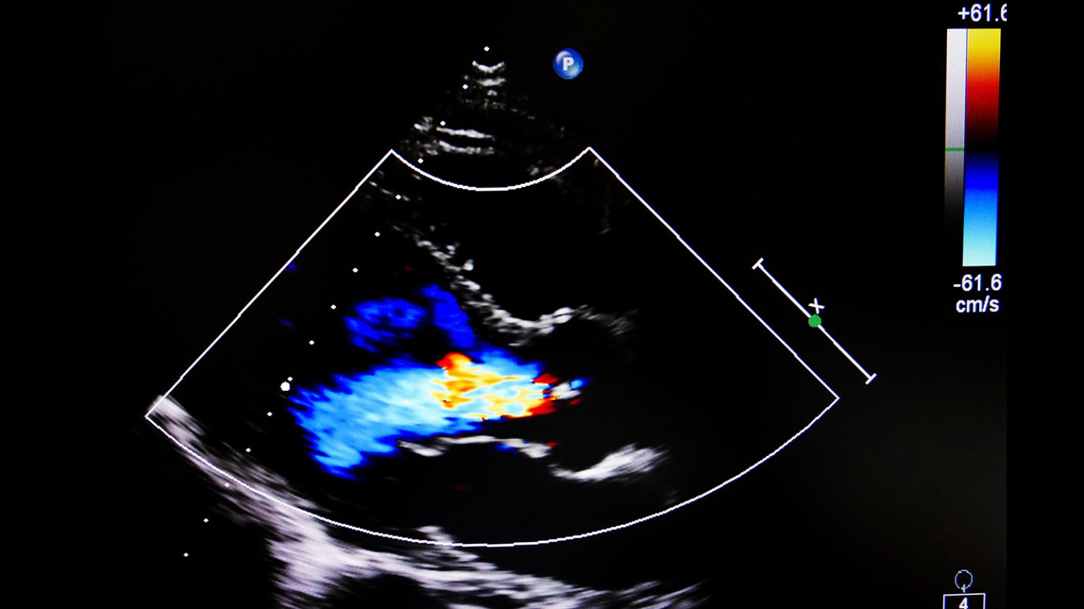 Encouraging DOAC Data for Afib With Various Valvular Heart Diseases