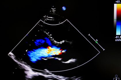 Encouraging DOAC Data for Afib With Various Valvular Heart Diseases
