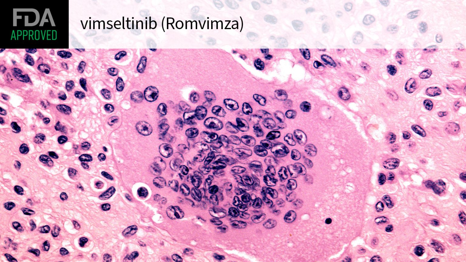 Second Drug for Benign Synovial Tumor Condition Wins FDA Approval
