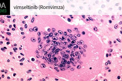 Second Drug for Benign Synovial Tumor Condition Wins FDA Approval