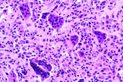 FDA Approves Vimseltinib for Tenosynovial Giant Cell Tumors
