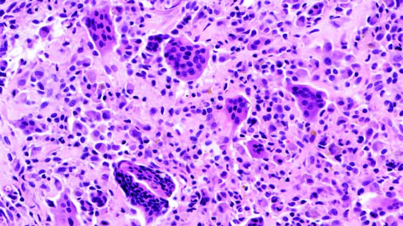 FDA Approves Vimseltinib for Tenosynovial Giant Cell Tumors