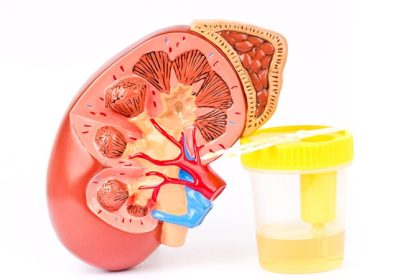 Urine Test Strips Show Promise for Kidney Disease Screening