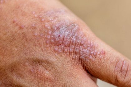 Real-World Study Reveals Early Success of Upadacitinib in AD