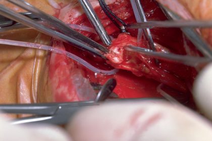 Clot-Busting Ultrasound Gives Carotid Endarterectomy a Step Up