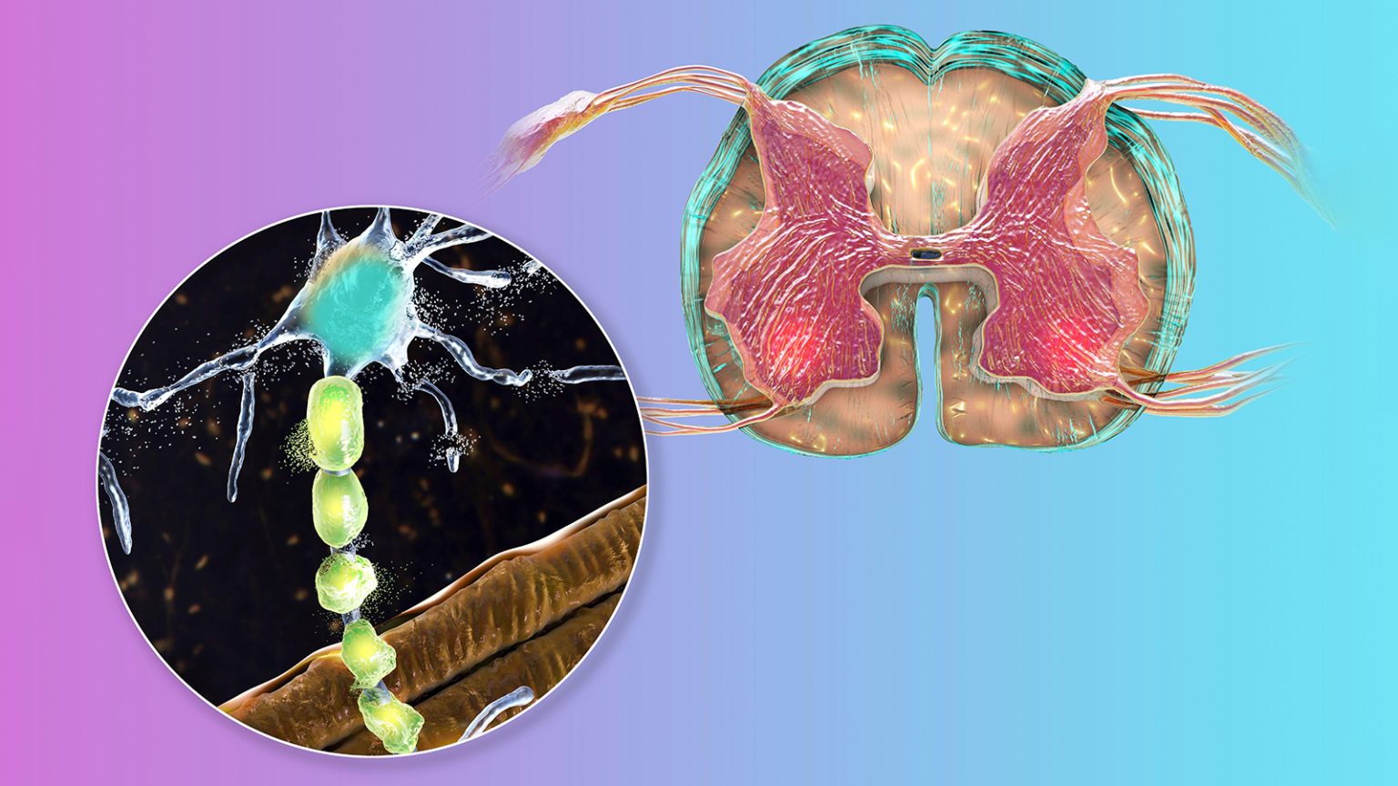 Two Investigational Treatments for ALS Show Glimmer of Hope